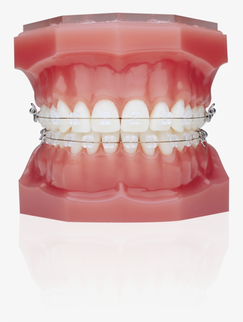 Ceramic Braces Vs Invisalign, transparent png #2148258