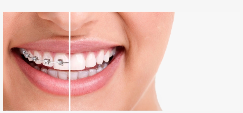 Woman Smiling Braces No Braces - Dental Braces, transparent png #2148422