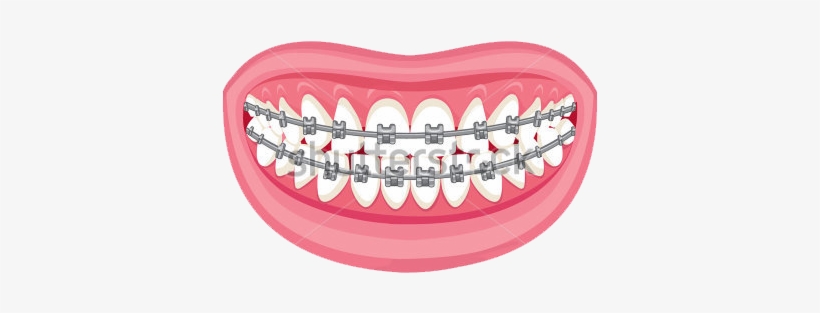 Braces And Aligners - Braces Cartoon No Background - Free Transparent