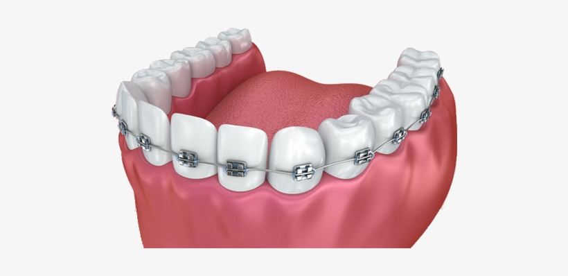 Braces - Dental Braces, transparent png #2149278