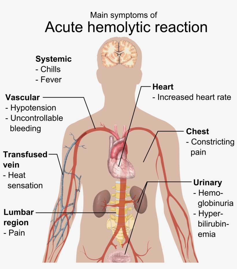 Main Symptoms Of Acute Hemolytic Reaction - Acute Hemolytic Reaction, transparent png #2161052