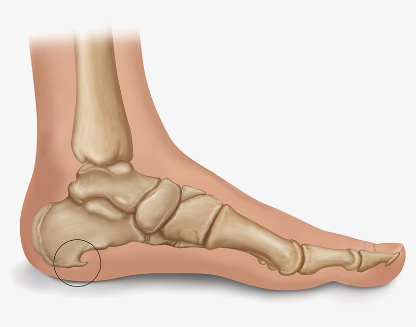 Heel Spur Illustration - Heel Spur, transparent png #2189315