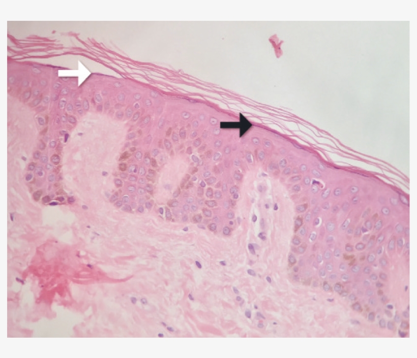 Pigmentación Uniforme De La Capa Basal, Hiperqueratosis - Painting, transparent png #220672