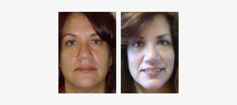 Nose Surgery Before & After Photos - Girl, transparent png #221299