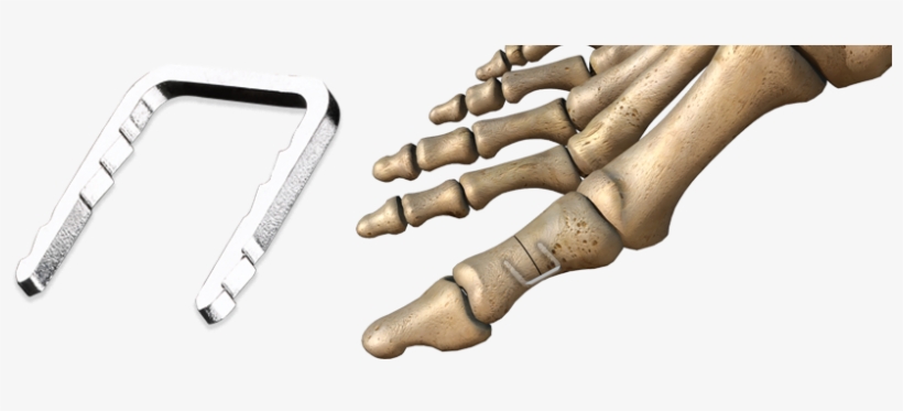 Charlotte™ Quick Staple - Bunion, transparent png #2261771