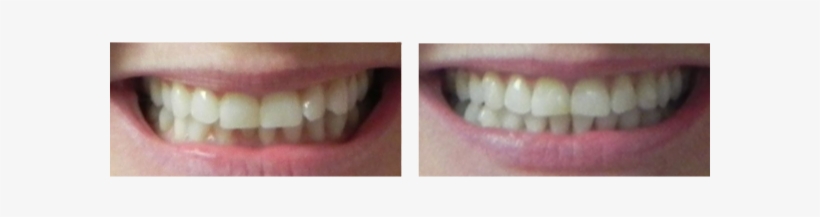 Before And After Orthodontics Treatment Case - Dental Braces, transparent png #2272659