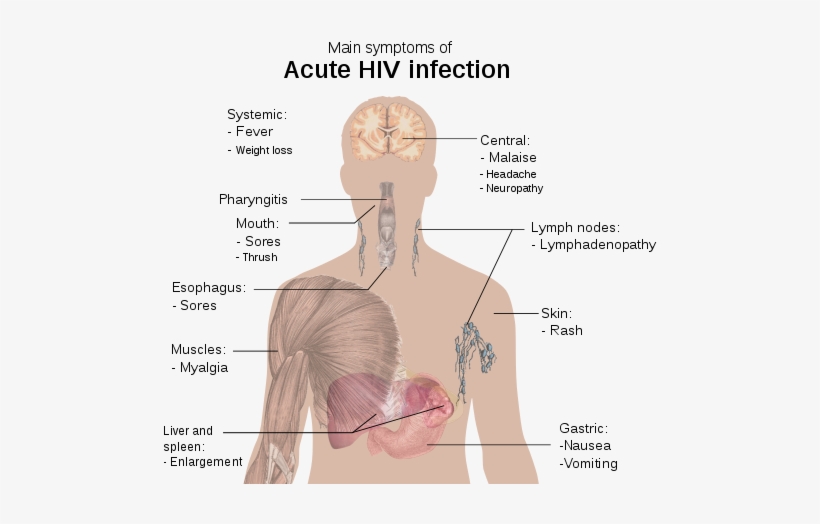 Nwo's The Club Of Rome, Genocide And You - Hiv Aids Virus Symptoms, transparent png #2273734