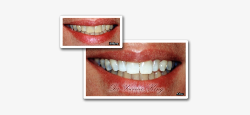 White Teeth Png Index Of - Tooth Whitening, transparent png #2273861