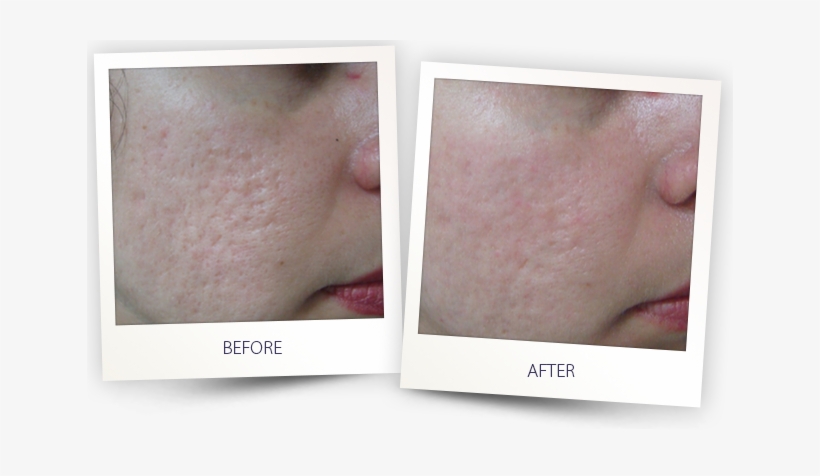 Legato Laser For Acne Scars, transparent png #2284116