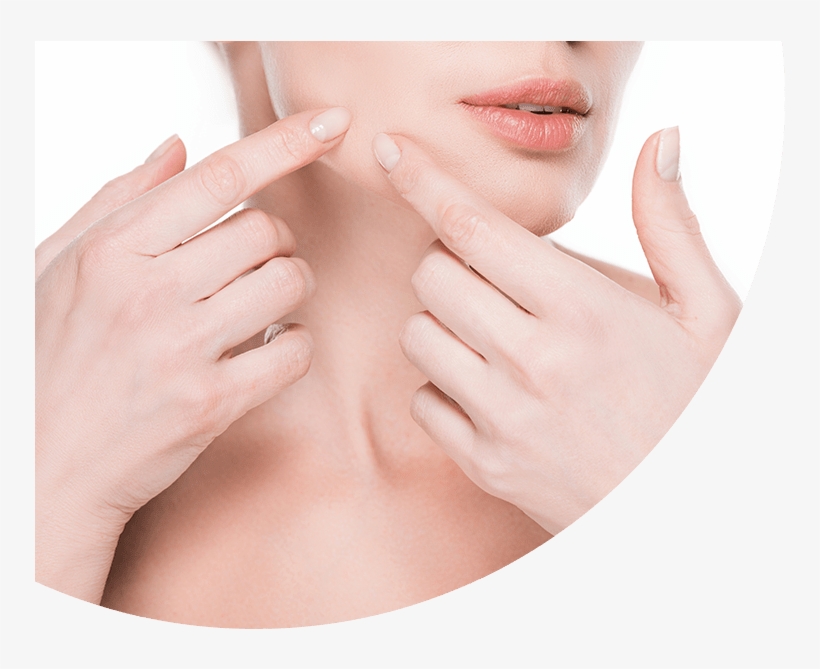 Acne Face, transparent png #2284256