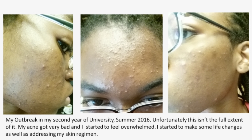 Second Year Acne Before - Acne, transparent png #2284740