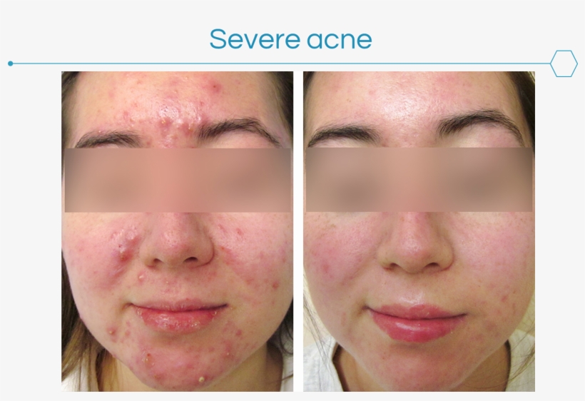 Acne Can Be Very Frustrating To The Patient And Have - Acne, transparent png #2284780