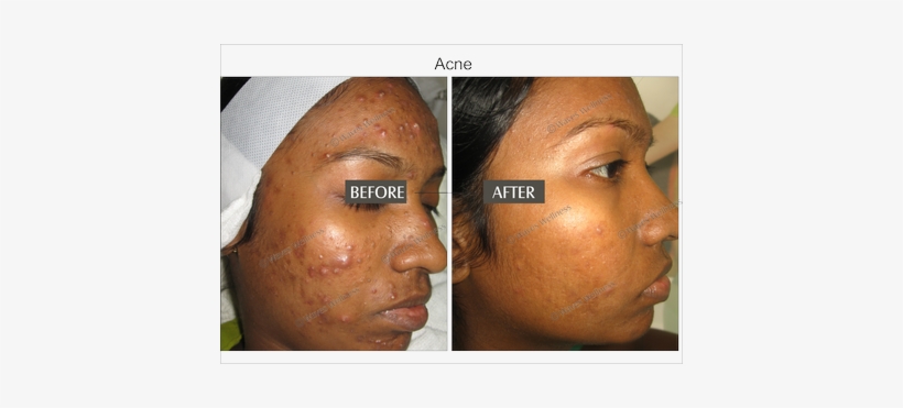 Acne And Marks - Acne, transparent png #2284832