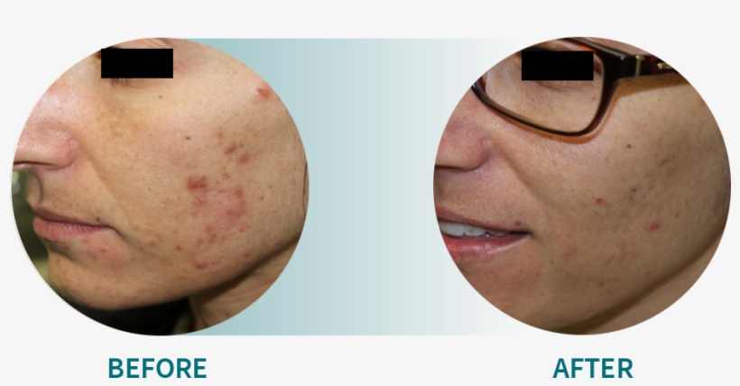 Active Acne/acne Scars - Stretch Marks Before And After, transparent png #2284884