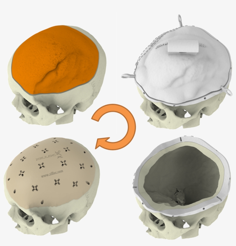 Meningioma 1 Stage - Cake, transparent png #230743
