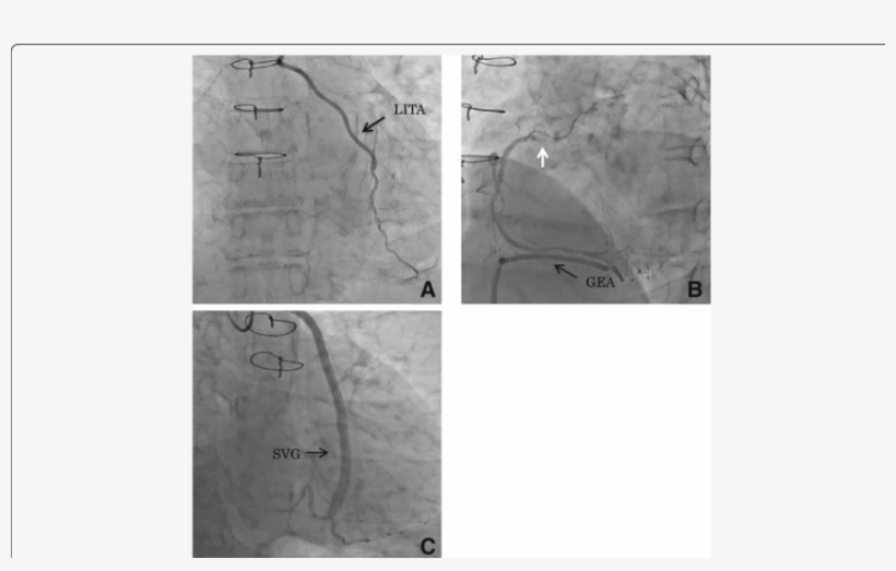 Preoperative Coronary Angiogram - Coronary Catheterization, transparent png #2330756