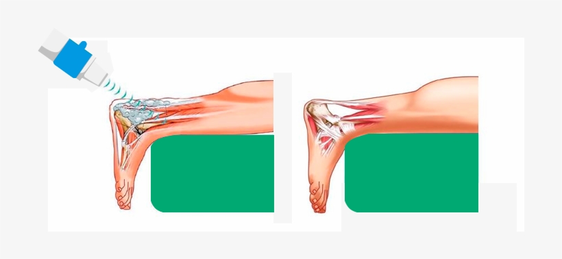 Extracorporeal Therapy Eswt Epat - Extracorporeal Shock Wave Plantar Fasciitis, transparent png #2349217