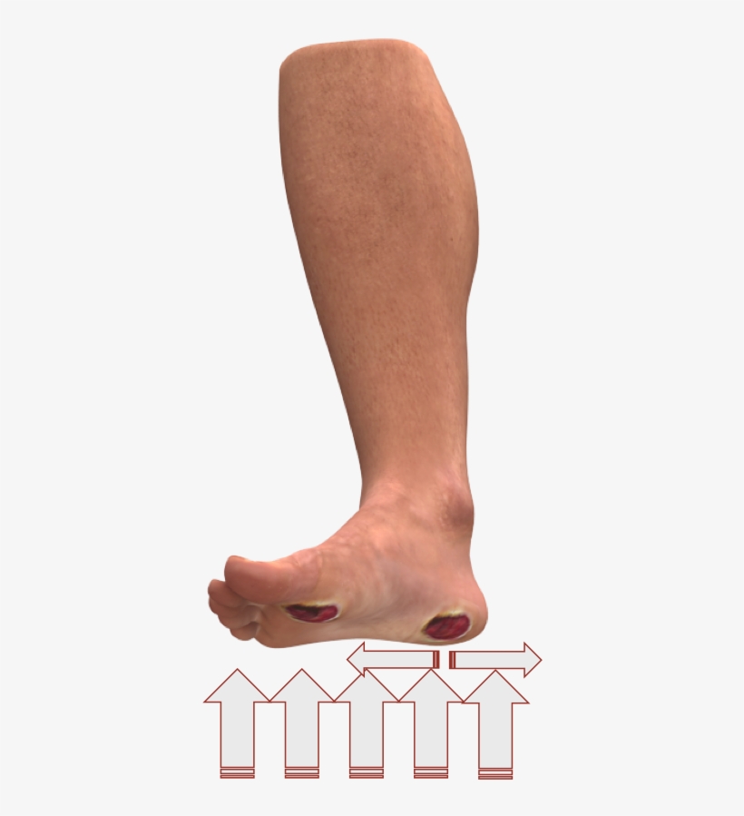 Physical Causes Of Diabetic Foot Ulcers - Diabetic Foot Ulcer, transparent png #2373730