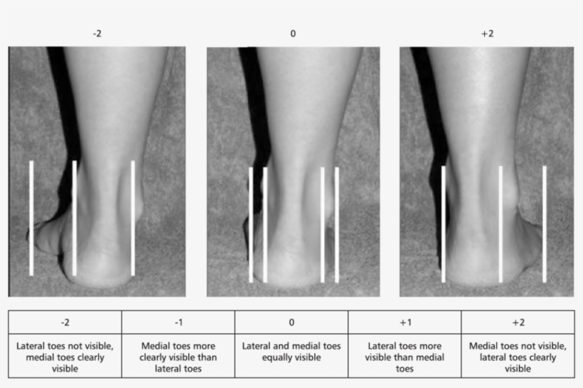 The Evaluation Of The Abduction/adduction Of The Forefoot - Foot Adduction, transparent png #2373933
