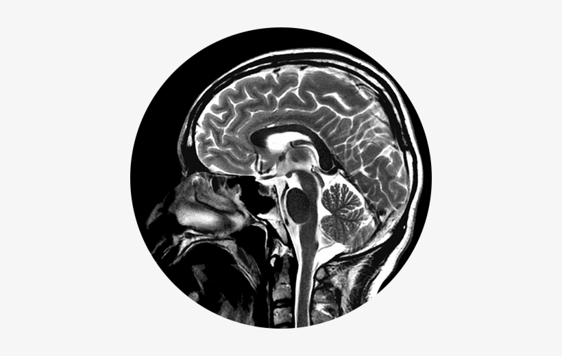Brain, Head & Spine Imaging Image - Lmp Enfermedad, transparent png #2382918