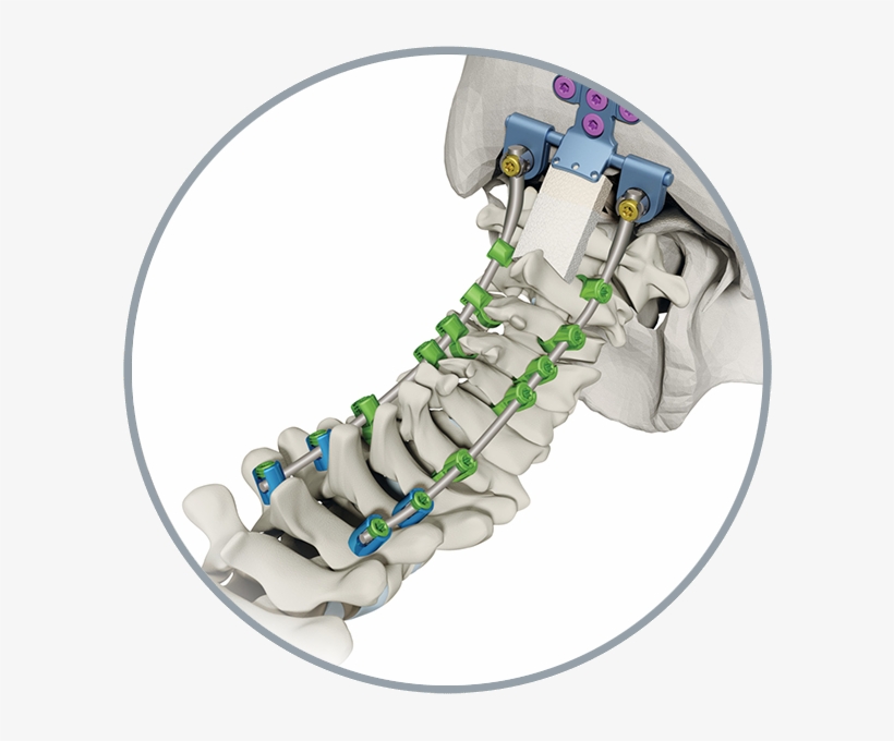 Atec Spine Products Solanas Featured Image - Nuvasive Vuepoint, transparent png #2383188