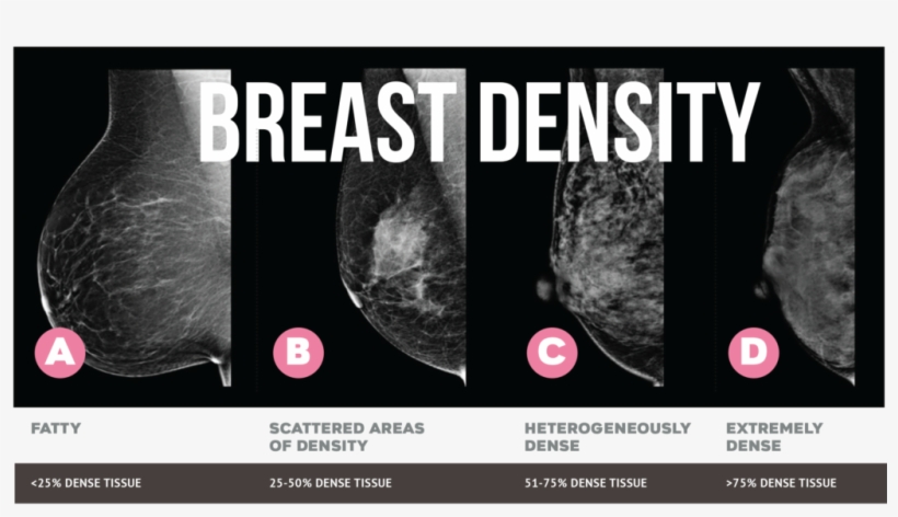 A Rather Convincing Estimation Of Breast Density Can - You Will Be More Disappointed, transparent png #2387343