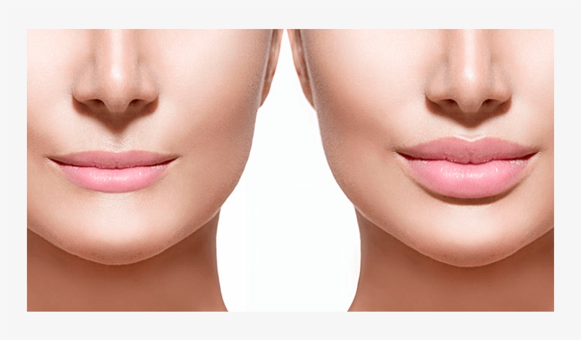 Relleno Labios - - 0.5 Ml Lips Before And After, transparent png #2390931