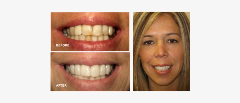 Dental Smile - Dr. Philip M. Tornatore, Dds - Dentist In Hicksville, transparent png #2394904