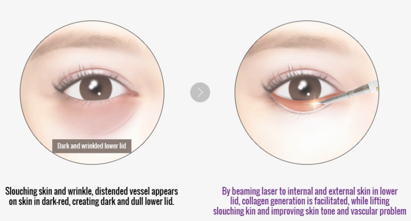 Some People May Notice Dark Under Eye Circles Moving - Eyelash Extensions, transparent png #251428