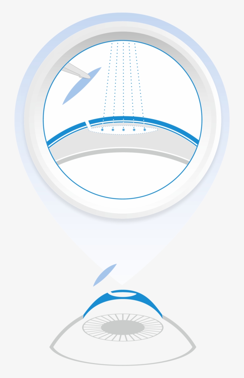 The New, Third-generation Smile Laser Surgery Unites - Circle, transparent png #253819