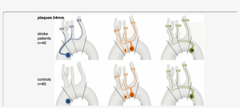 Number Of Plaques ≥4 Mm In Each Section Of The Aorta - Illustration, transparent png #254275