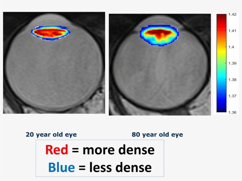 Images Of The Eye Under Mri - Microsoft Office 2003, transparent png #2549336