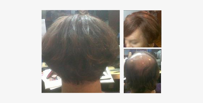 For A Person With Medical Conditions Such As Alopecia, - Lace Wig, transparent png #2573931