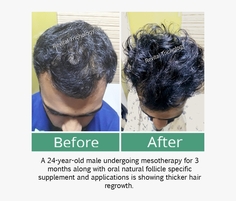 Hair Loss In Men - Lace Wig, transparent png #2574240