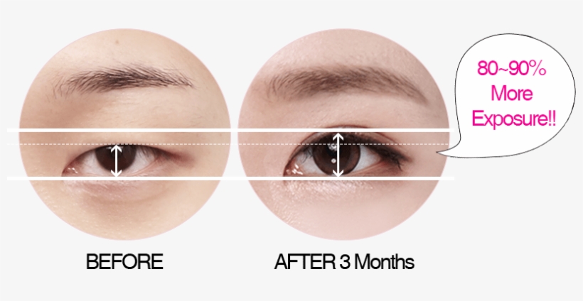 What Is Da's Ptosis Correction - Eye Shadow, transparent png #2591574