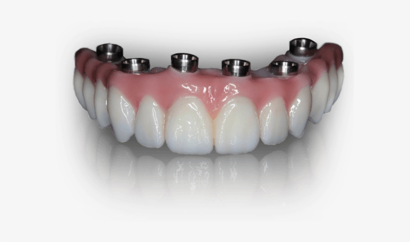 Prettau Zirconia - Teeth In A Day, transparent png #268910