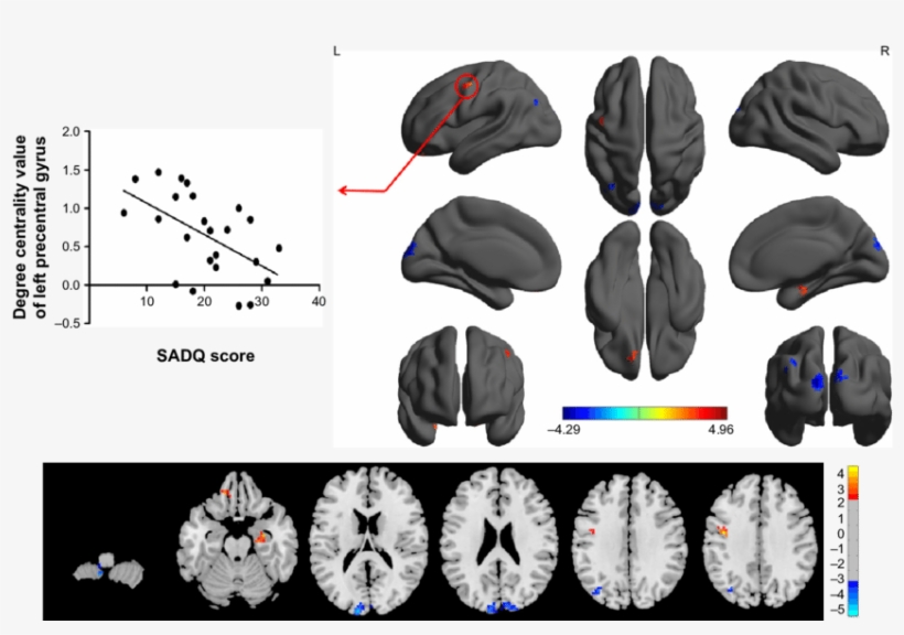 Between-group Differences In Binarized Degree Centrality - Superior Temporal Gyrus, transparent png #2606471