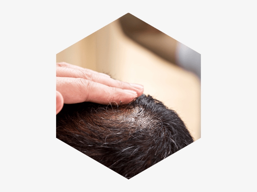 Causes Of Hair Loss In Men - Hair Loss, transparent png #2615310