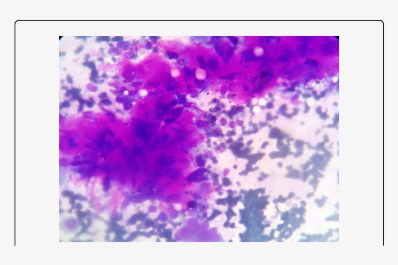 Clusters Consisting Of Tumor Cells With Spindle Cell - Spindle Cell Carcinoma, transparent png #2663493