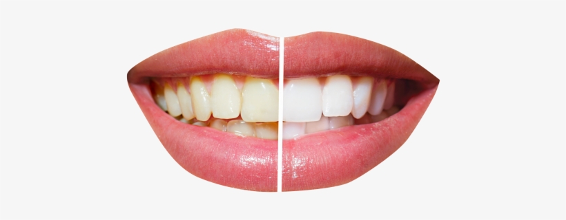 Teeth Whitening Png Transparent Image - Dentistry Before And After, transparent png #277370