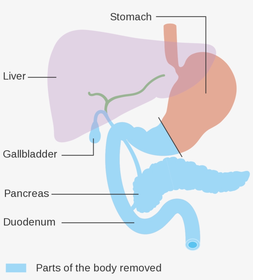 Total Pancreatectomy, transparent png #2728834