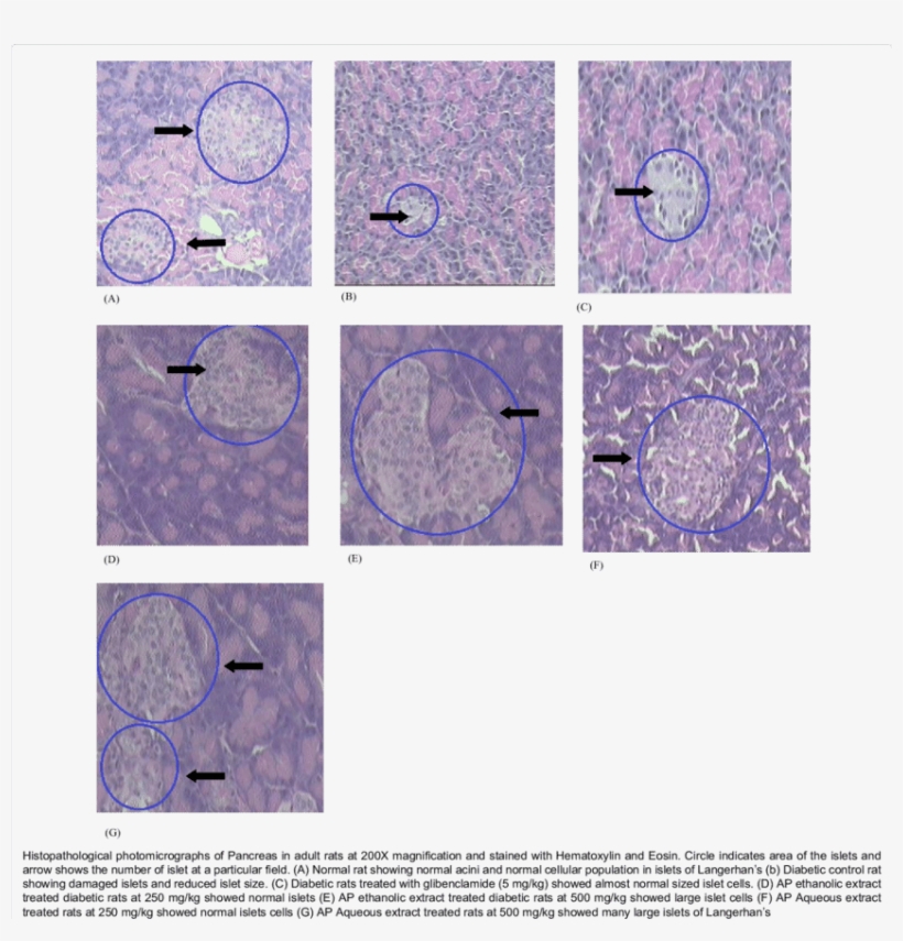 Histopathological Photomicrographs Of Pancreas - Diabetes Mellitus, transparent png #2728927