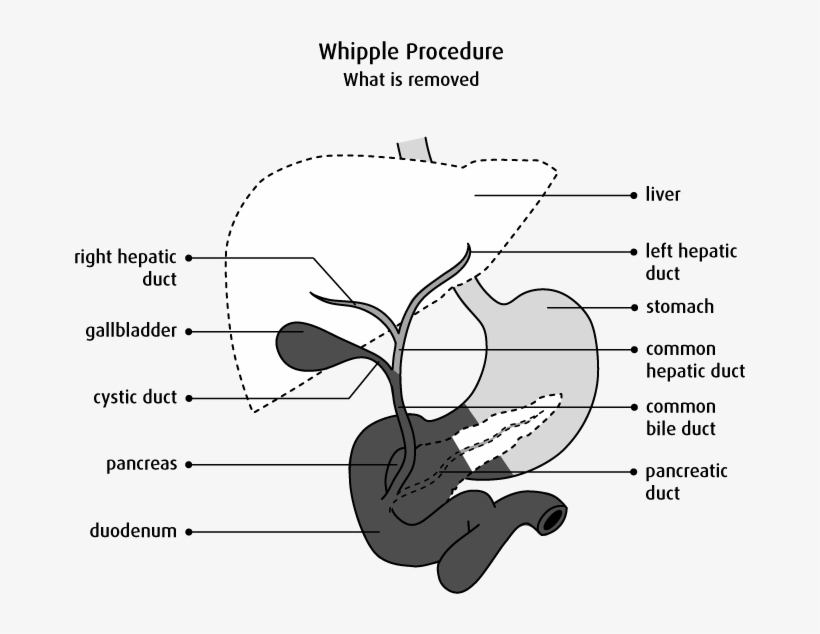 Diagram Of What Is Removed In A Whipple Procedure - Biliary Tree Diagram, transparent png #2728945