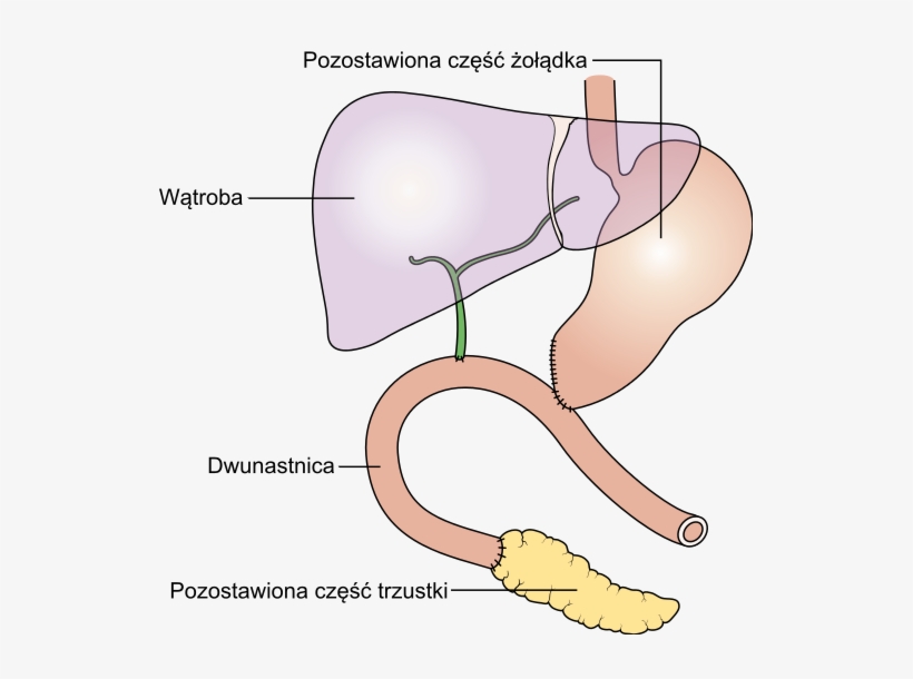 Diagram Showing How The Pancreas And Bowel Is Joined - Pancreatectomy, transparent png #2728947