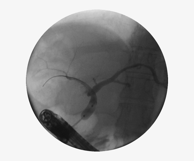 Dilation Of A Stricture With The Hurricane Rx Biliary - Hurricane Balloon, transparent png #2737083