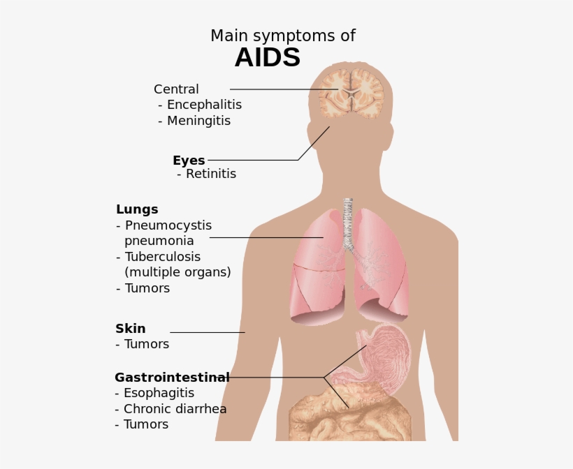 Symptoms Of Aids - Know If You Have Aids, transparent png #2742387