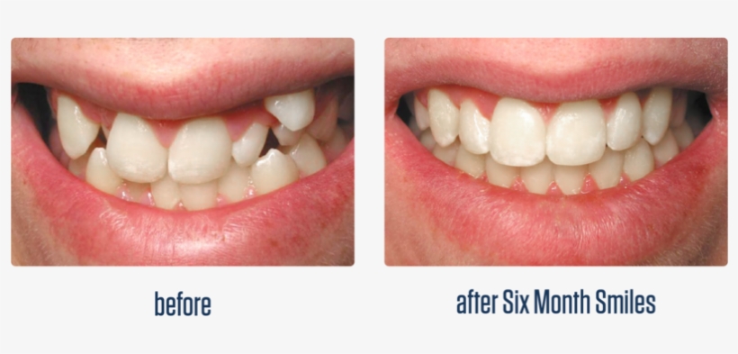 Gallery-07 - Before And After Six Month Smiles, transparent png #2748726