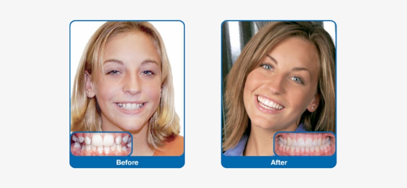 Damon Smile - Damon Braces Before And After Adults, transparent png #2748780