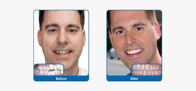 Damon Smile - Damon Braces Adults Before After, transparent png #2748925