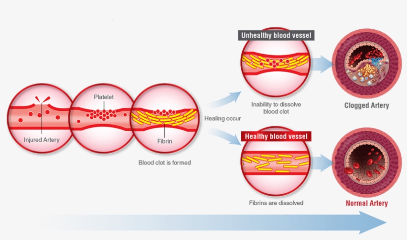If Fibrinolytic Activity Is Decreased , Blood Clot - Nattokinase, transparent png #2774053